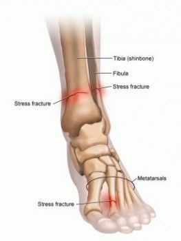 Lower Limb Bones