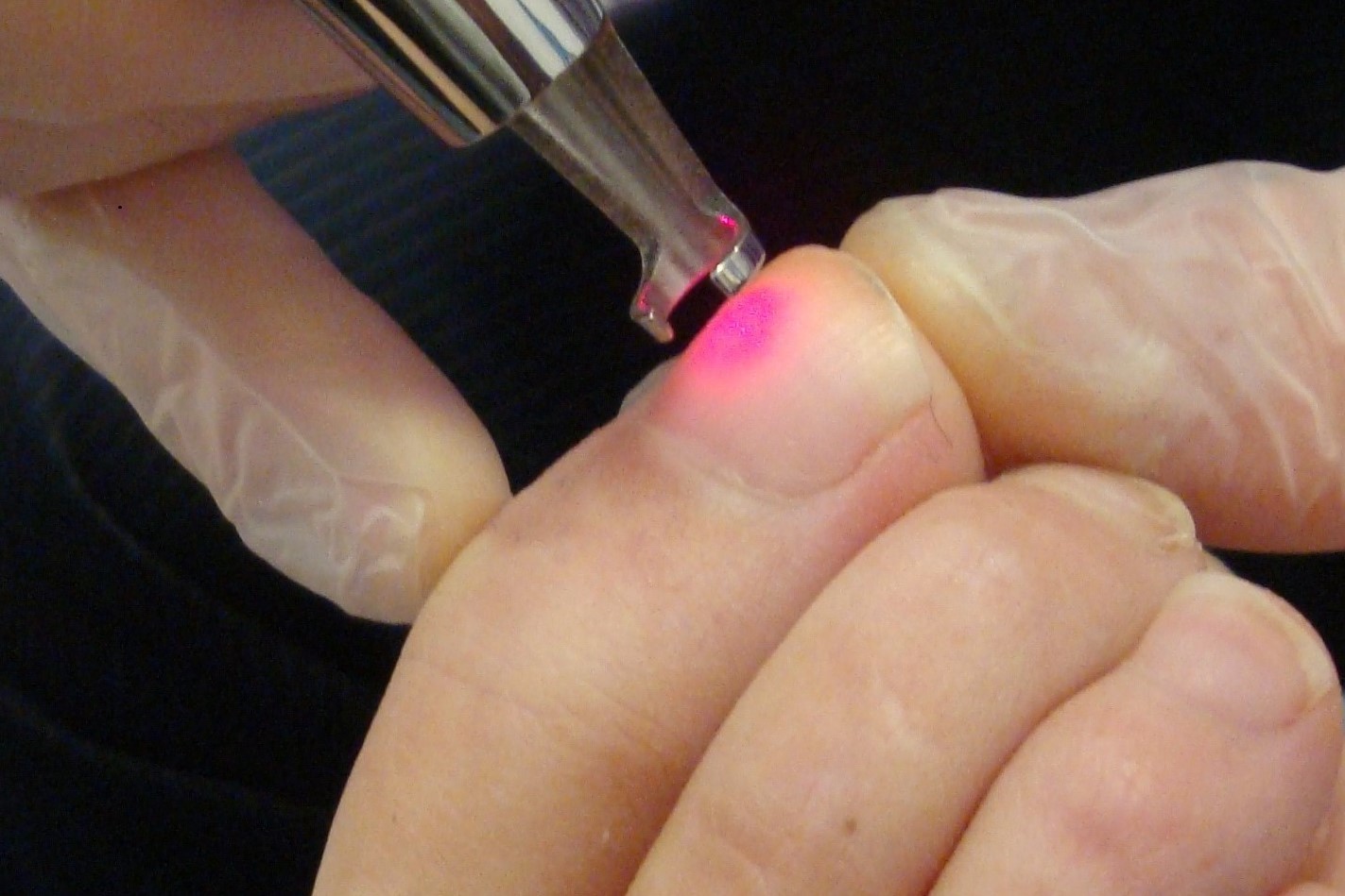 Laser for fungal nail