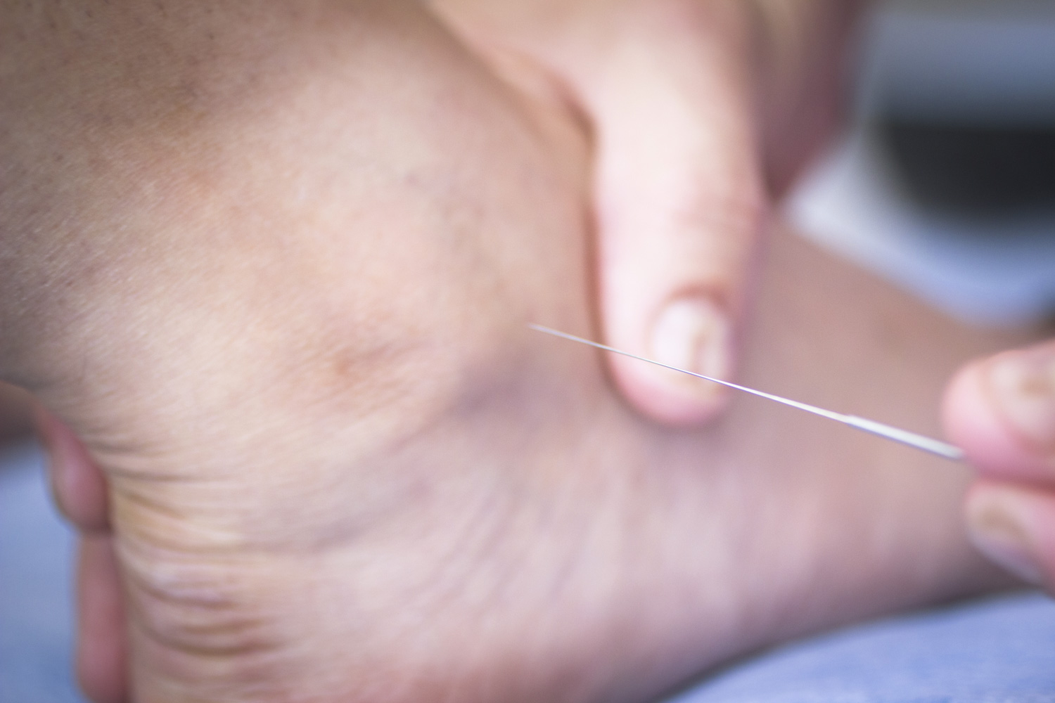 Dry needling treatment on a person's foot